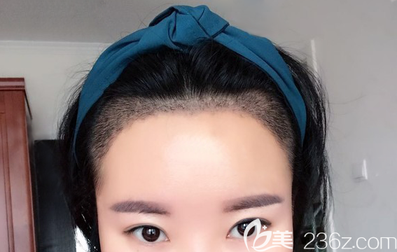 植發(fā)術(shù)后15天的恢復(fù)情況