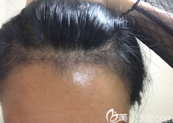 發(fā)際線種植3個月脫落期時候的照片