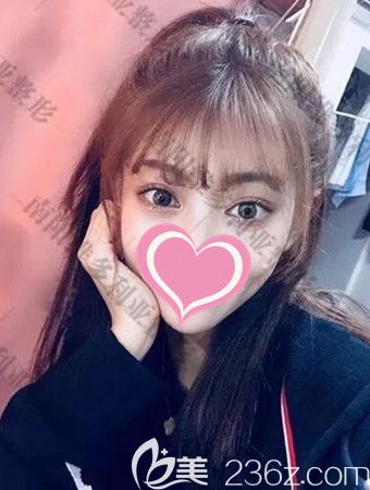 雙眼皮手術(shù)后30天的恢復(fù)照片 雙眼皮手術(shù)后30天的恢復(fù)照片