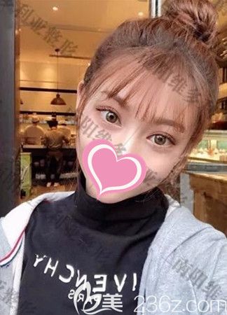 糾結(jié)雙眼皮做哪個(gè)好后選了全切8mm手術(shù)恢復(fù)后效果你來評價(jià)