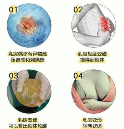 做完假體隆胸出現(xiàn)后遺癥后悔了
