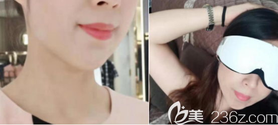 我用五年的時(shí)間來(lái)向大家證明假體墊下巴會(huì)發(fā)生磨骨和移位現(xiàn)象是謠言