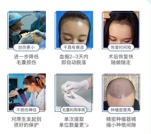毛發(fā)移植手術(shù)的過程步驟 毛發(fā)移植手術(shù)的過程步驟