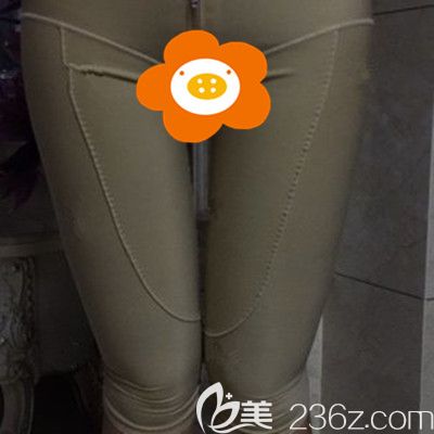 術(shù)后第7天還有點腫 術(shù)后第7天還有點腫