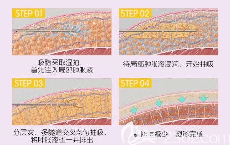 李啟飛做水動力吸脂手術(shù)過程 李啟飛做水動力吸脂手術(shù)過程