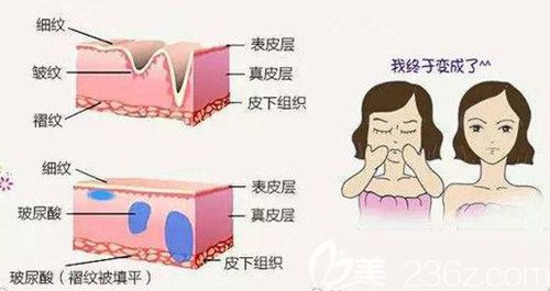 黃彩龍醫(yī)生注射玻尿酸除皺過程