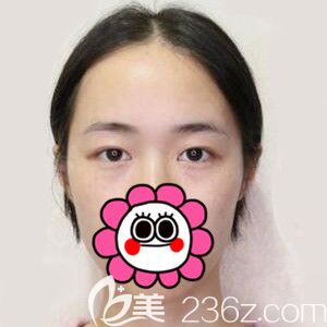 做定點(diǎn)雙眼皮開(kāi)眼角術(shù)前照 做定點(diǎn)雙眼皮開(kāi)眼角術(shù)前照