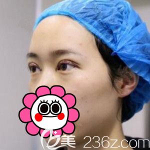 做完定點(diǎn)雙眼皮術(shù)后即刻<span style= 做完定點(diǎn)雙眼皮術(shù)后即刻<span style=