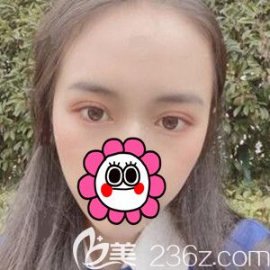 做定點(diǎn)雙眼皮開(kāi)眼角術(shù)后半個(gè)月恢復(fù)<span style= 做定點(diǎn)雙眼皮開(kāi)眼角術(shù)后半個(gè)月恢復(fù)<span style=