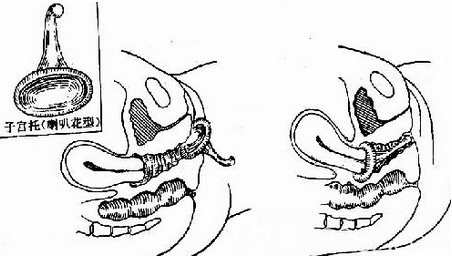 為什么生完孩子的女人更容易發(fā)生漏尿現(xiàn)象呢？