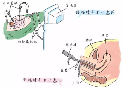 通過(guò)子宮下垂矯正能夠改善漏尿現(xiàn)象嗎？