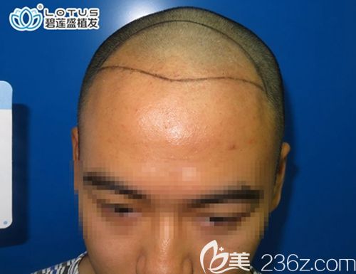 術(shù)前前額頭頂頭發(fā)稀疏 術(shù)前前額頭頂頭發(fā)稀疏