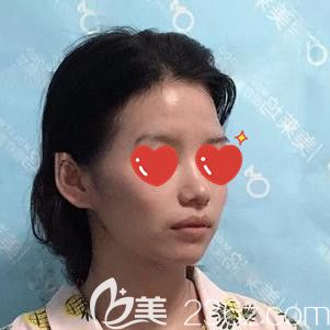 我的臉上沒有膠原蛋白還顴弓外擴(kuò) 我的臉上沒有膠原蛋白還顴弓外擴(kuò)