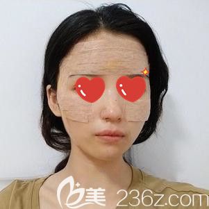 面部脂肪填充后粘的固定膠帶 面部脂肪填充后粘的固定膠帶