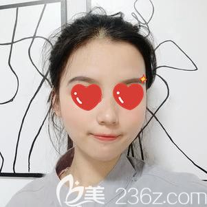 脂肪填充18天面部飽滿 脂肪填充18天面部飽滿