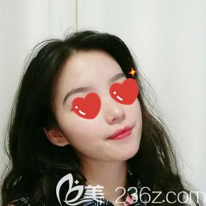 面部填充術(shù)后47天脂肪少數(shù)被吸收 面部填充術(shù)后47天脂肪少數(shù)被吸收