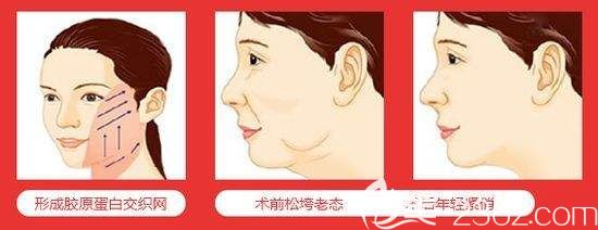 埋線提升可明顯改善衰老