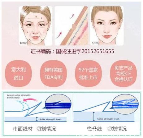 意大利悅升線材：可吸收，適應(yīng)范圍廣