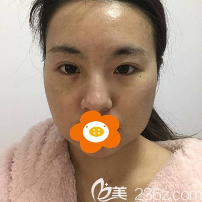 做面部吸脂手術(shù)前的照片 做面部吸脂手術(shù)前的照片