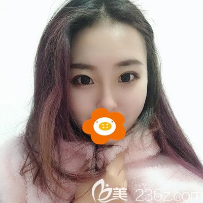 面頰,雙下巴,下頜緣3個部位一起做面部吸脂，趕走了我的大臉盤子！