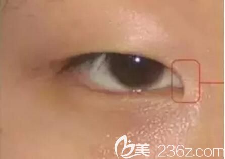 內(nèi)眥贅皮 內(nèi)眥贅皮