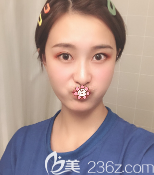 之前顴骨突出做自體脂肪填充后臉型順眼了很多 也沒感染或其他后遺癥