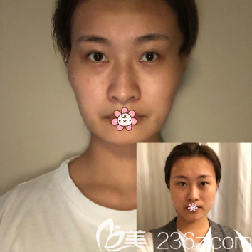 術(shù)前術(shù)后對比 術(shù)前術(shù)后對比