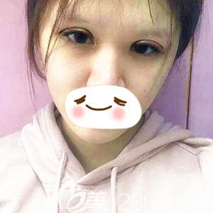 剛做完眼綜合手術(shù)后眼睛腫脹感較強(qiáng) 剛做完眼綜合手術(shù)后眼睛腫脹感較強(qiáng)