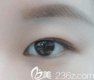 內(nèi)雙的人適不適合割雙眼皮？