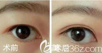 內(nèi)雙割雙眼皮術(shù)前術(shù)后對(duì)比照