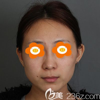 玻尿酸豐唇前我的照片 玻尿酸豐唇前我的照片