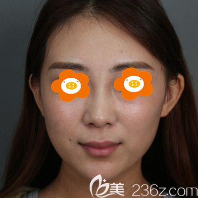 術(shù)后一周照片 術(shù)后一周照片