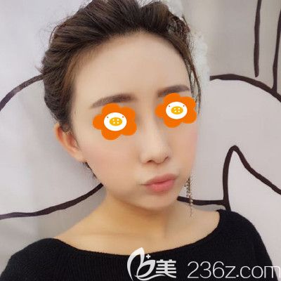 注射2ml愛芙萊玻尿酸豐唇已經(jīng)40天，頭一次填充吸收的挺好！