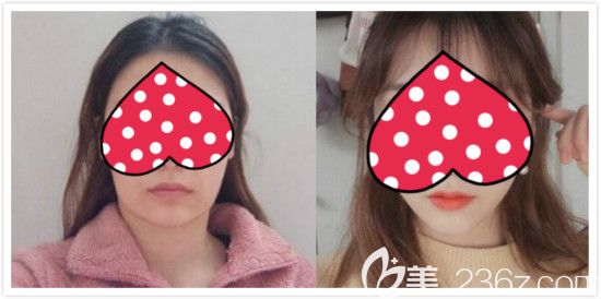 長(zhǎng)曲線下頜角截骨一年后對(duì)比