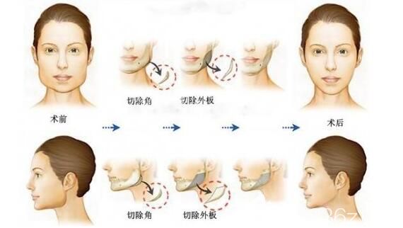 下頜角截骨手術(shù)原理示意圖
