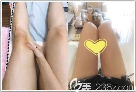 大腿吸脂親身經(jīng)歷者術(shù)后3個(gè)月效果反饋