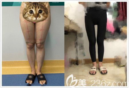 大腿環(huán)吸效果反饋