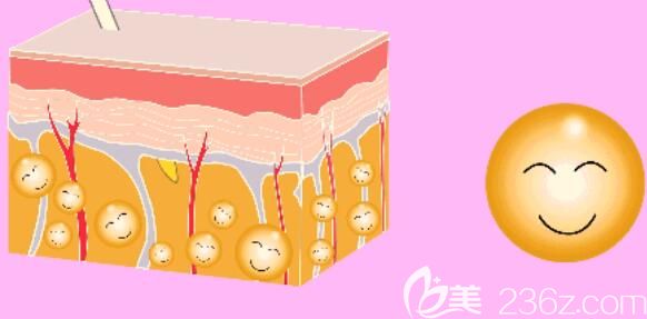 大腿吸脂手術(shù)直接減少細(xì)胞數(shù)量