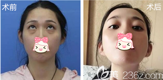 祛眼袋術前術后的我對比 祛眼袋術前術后的我對比