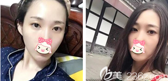 老實(shí)說我也驚訝頭一回做內(nèi)切祛眼袋手術(shù)沒失敗沒凹陷也看不出疤