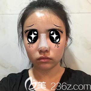 剛做完肋軟骨隆鼻手術(shù)的我