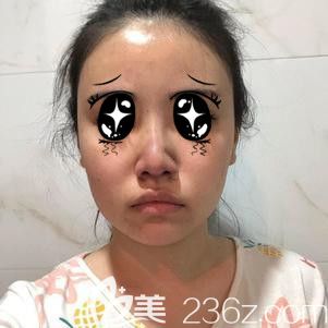 隆鼻術(shù)后第7天拆線后和術(shù)前沒(méi)啥變化