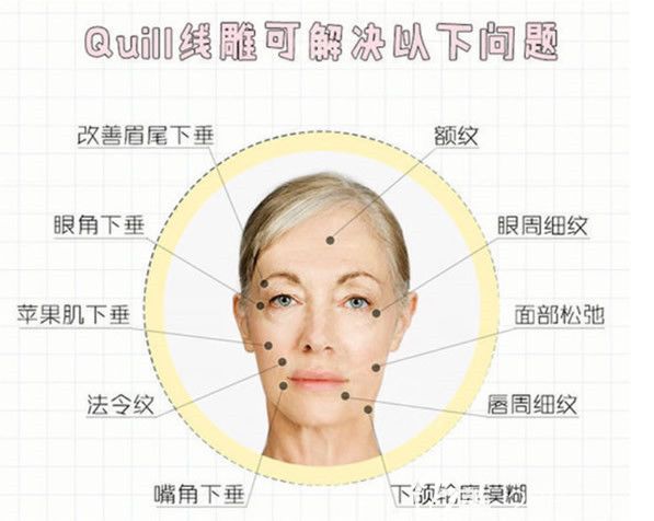 快翎線可以解決哪些面部衰老問題 快翎線可以解決哪些面部衰老問題