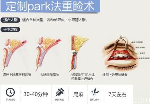 李詹哲醫(yī)生做改良Pake法重瞼術(shù)過程 李詹哲醫(yī)生做改良Pake法重瞼術(shù)過程