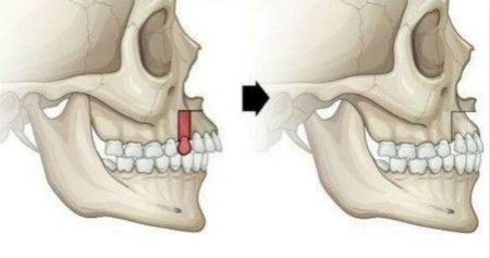 真凸嘴和假凸嘴區(qū)別介紹