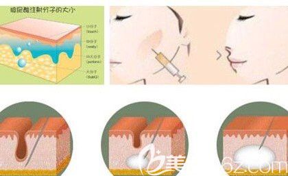薛華棟醫(yī)生注射玻尿酸塑形 薛華棟醫(yī)生注射玻尿酸塑形