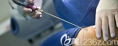 腹部吸脂手術的過程和原理