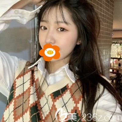 我做了期待已久的自體脂肪豐臉頰，存活率不錯(cuò)臉上滿滿的膠原蛋白！