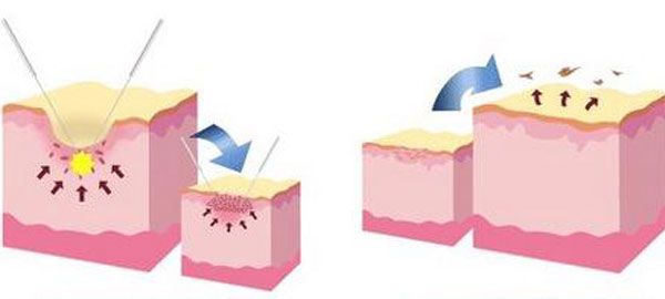 <!--<i data=20240703-sp></i>-->醫(yī)生主要研究瘢痕的細(xì)胞生物學(xué)特性 <!--<i data=20240703-sp></i>-->醫(yī)生主要研究瘢痕的細(xì)胞生物學(xué)特性