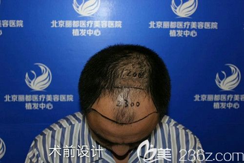 前額發(fā)際線加頭頂一共需種3500毛囊 前額發(fā)際線加頭頂一共需種3500毛囊